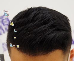 -大麦微针植发全国连锁