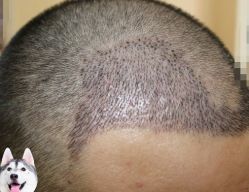 -大麦微针植发丨全国连锁