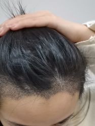 -大麦微针植发全国连锁