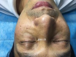 -爱莎扁平疣·汗管瘤·斑痣中心
