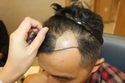 -大麦微针植发丨全国连锁