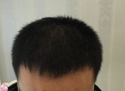 -大麦微针植发丨全国连锁