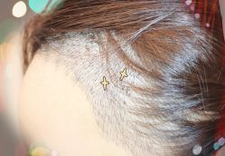 -大麦微针植发全国连锁