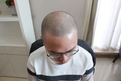 -大麦微针植发丨全国连锁