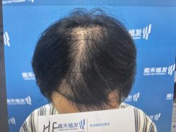 -雍禾植发