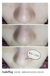 水氧+opt光疗-光SPA科技美肤