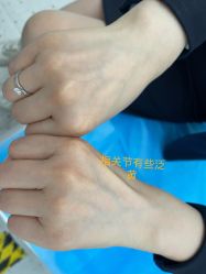 体验前-嘉和医学脱毛中心