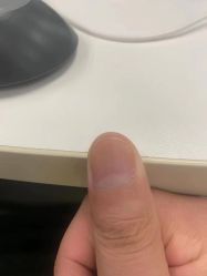 -德哥灰指甲脚气甲沟炎跖疣护理