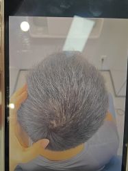 -大麦微针植发丨全国连锁