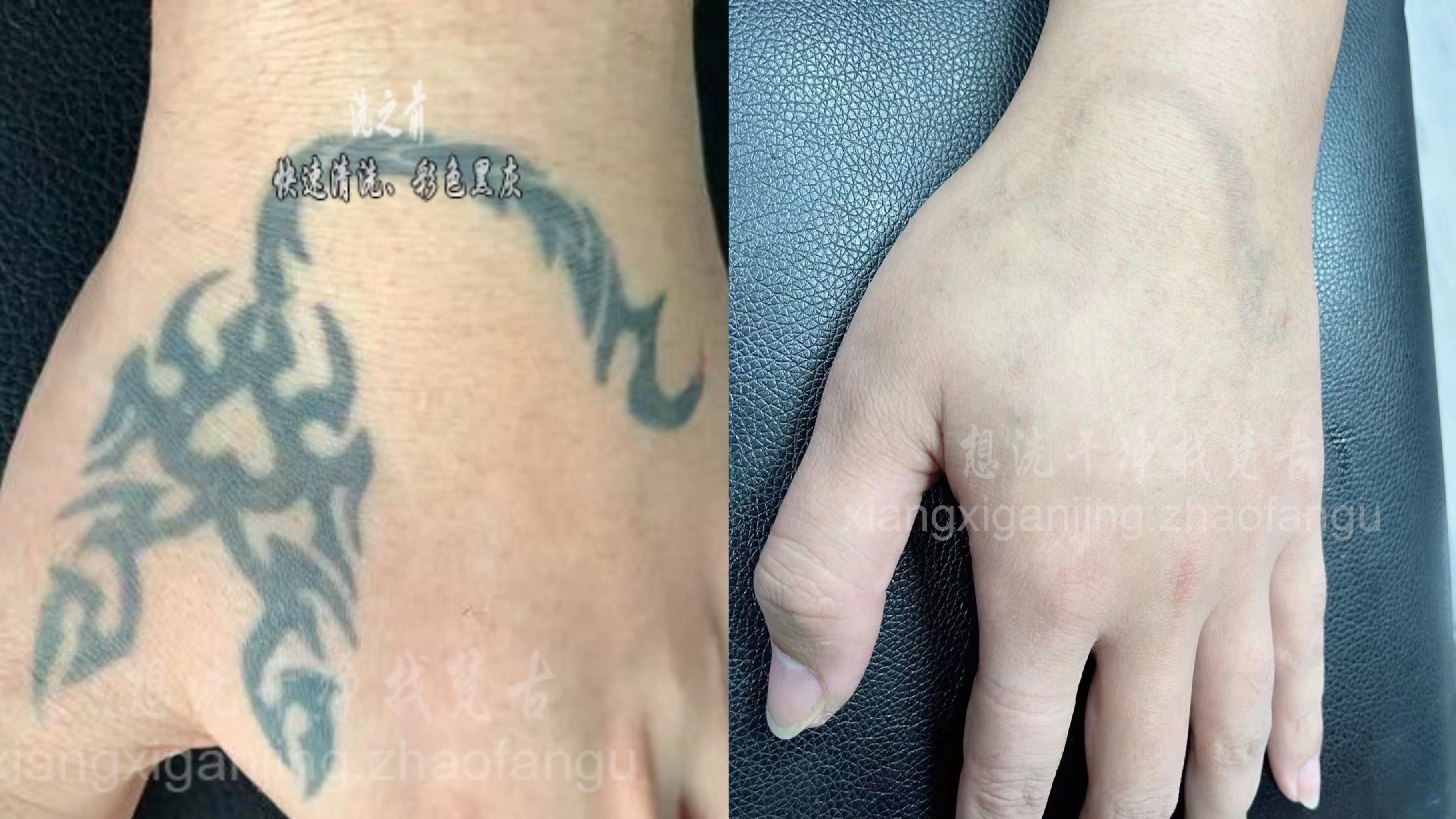 虎口蝎子清洗两次
还有一点残留色素再