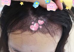 -大麦微针植发全国连锁