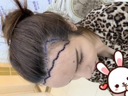 点击看大图 -大麦微针植发丨全国连锁