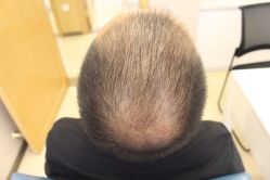 -大麦微针植发丨全国连锁