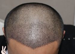 -大麦微针植发丨全国连锁