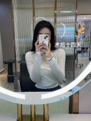 体验后-碧莲盛·不剃发植发