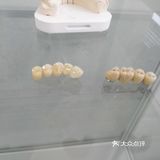 全瓷vs烤瓷