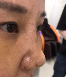 体验后-万州华美紫馨整形美容医院