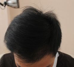 -大麦微针植发全国连锁