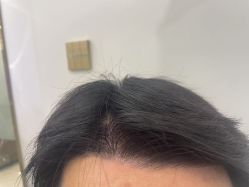 -碧莲盛·不剃发植发