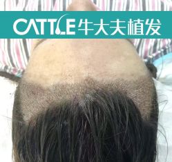 -牛大夫植发