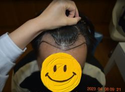 -大麦微针植发全国连锁