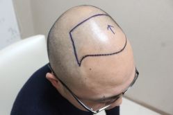 点击看大图 -大麦微针植发丨全国连锁