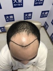体验前-大麦微针植发丨全国连锁