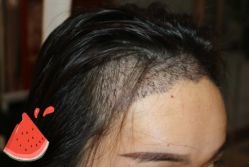 -大麦微针植发丨全国连锁