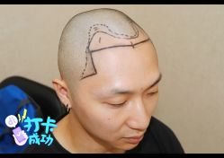 体验后-大麦微针植发全国连锁