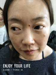 -北京美痣堂古方祛痣斑疣瘊