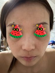 体验前-More摩尔医美の注射线雕光电中心