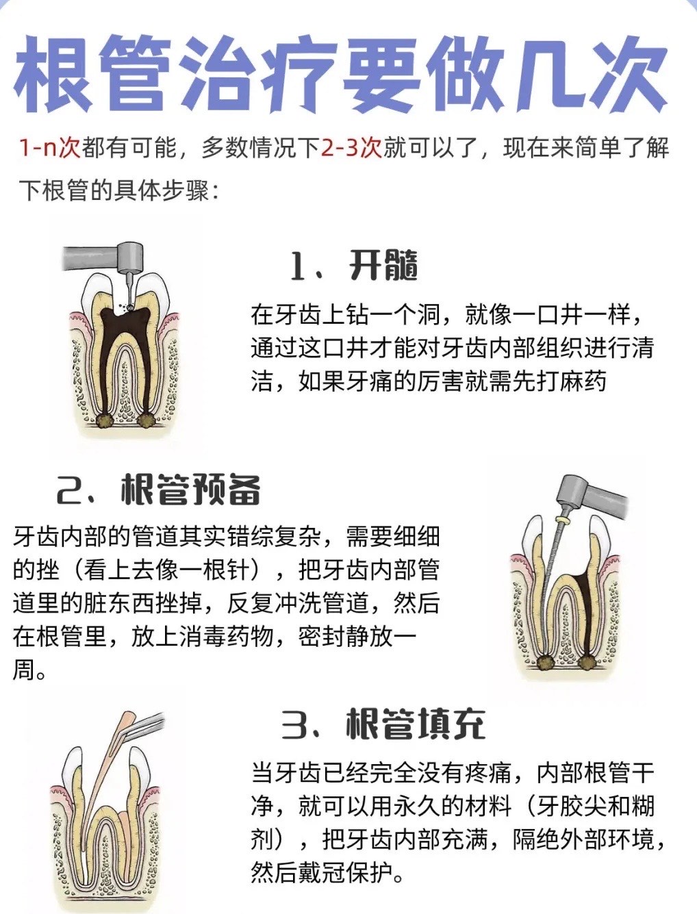 牙齿根管治疗图片步骤图片