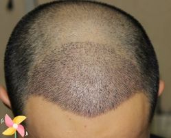 -大麦微针植发丨全国连锁