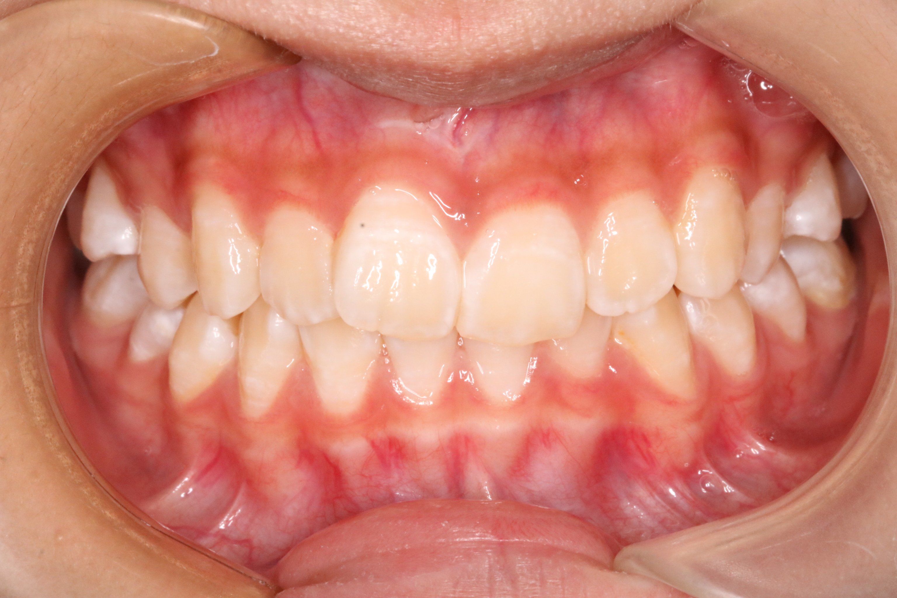 在杨医生的专业护理下,孩子的牙齿有了很大