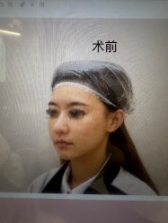 体验前-杭州米兰柏羽医疗美容医院