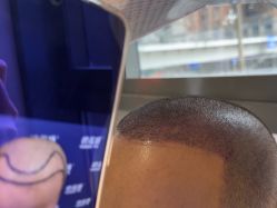 -碧莲盛·不剃发植发