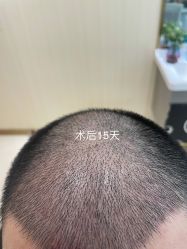 点击看大图 -碧莲盛·不剃发植发
