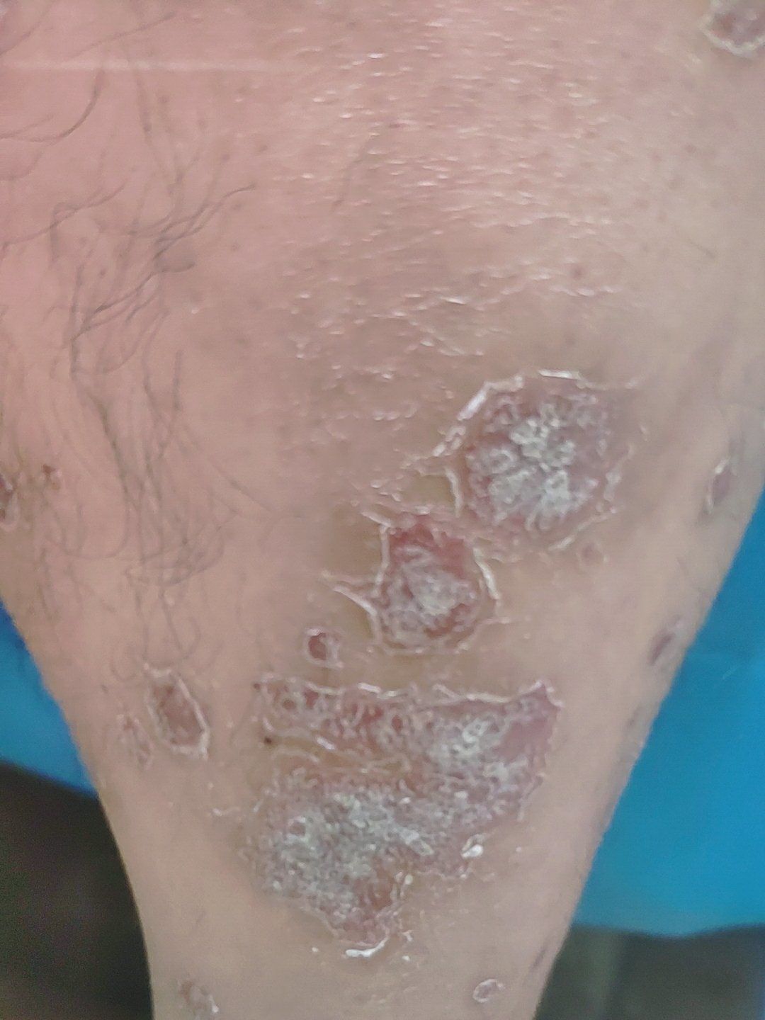 银屑病你们听说过吗?