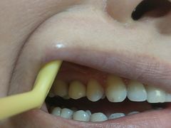 -上海仁爱医院口腔科 · 种植