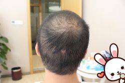 点击看大图 -大麦微针植发丨全国连锁