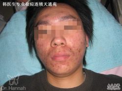 -韩医生专业祛痘连锁机构