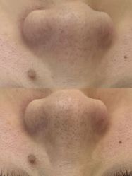 -凡碧诗毛孔清洁收细