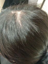 -碧莲盛·不剃发植发