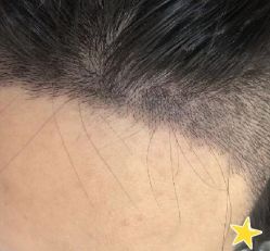 -大麦微针植发丨全国连锁