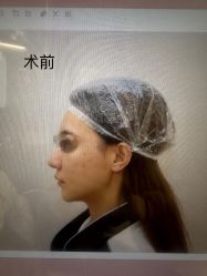 体验前-杭州米兰柏羽医疗美容医院