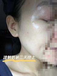 体验后-东剑医学美容·注射美学中心