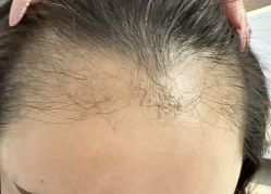 体验后-熙朵美学植发·连锁品牌