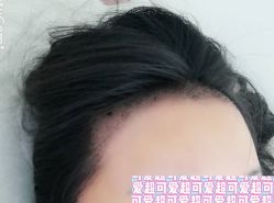 -大麦微针植发全国连锁