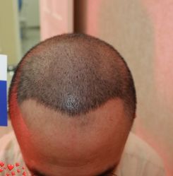 -大麦微针植发丨全国连锁