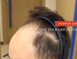 -大麦微针植发全国连锁